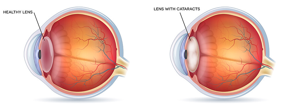 Chart Illustrating a Healthy Lens Compared to a Cataract