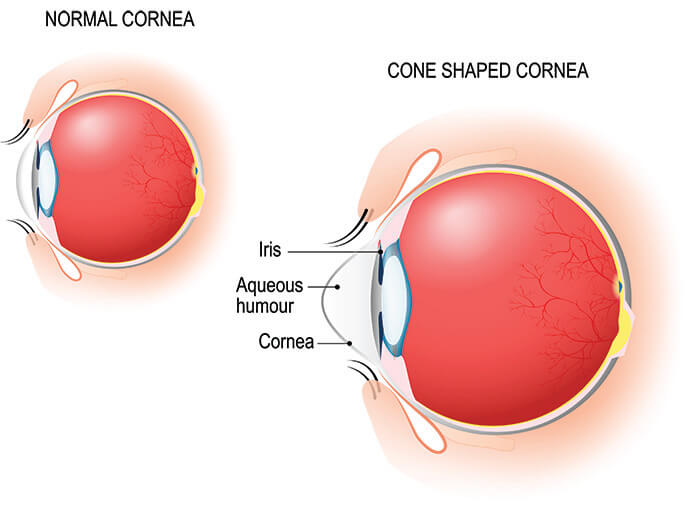 Chart Illustrating a Normal Cornea, Compared to a Cone Shaped Cornea