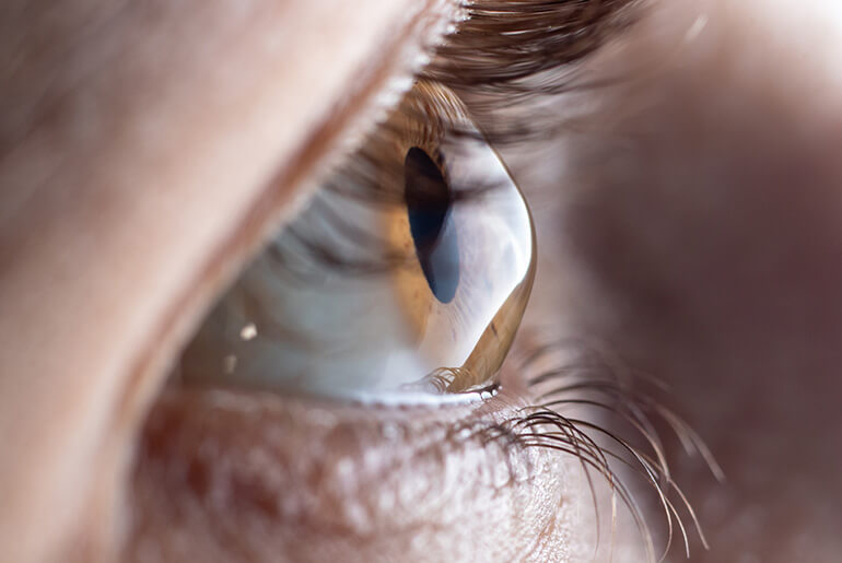 An Eye With Keratoconus