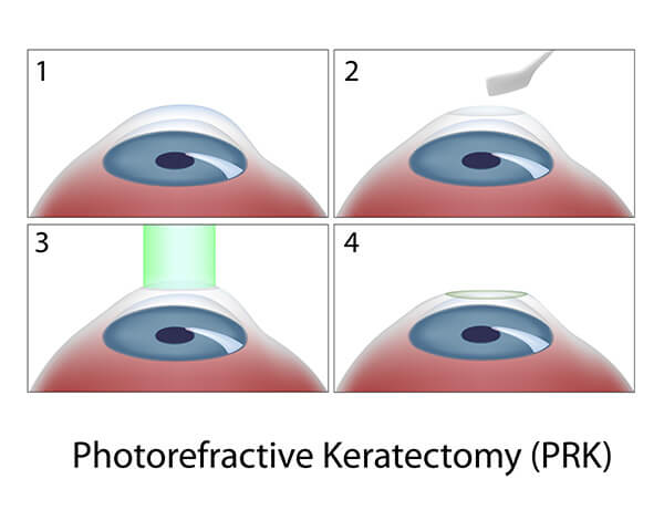 Chart Illustrating PRK Surgery